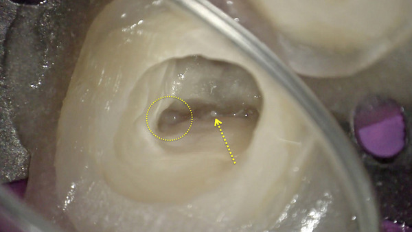 【根管治療・歯を残す】左下の奥歯の歯肉が腫れて顎まで痛い