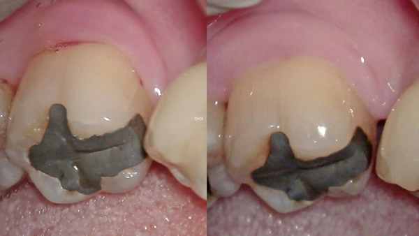 【歯周病治療・根分岐部病変】左下奥歯の歯肉の違和感が続く