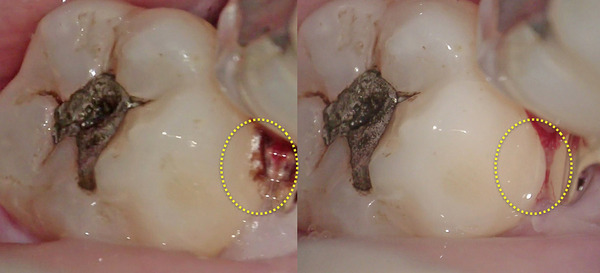 【歯周病治療】手術用顕微鏡(マイクロスコープ)を使用した右下奥歯の歯石除去
