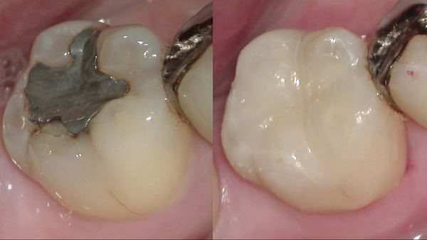 【むし歯(虫歯)治療・セラミック治療】右下奥歯の咬むと痛い方の治療