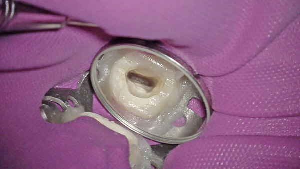 【根管治療・ラバーダム】右上の歯が痛む方の根管治療