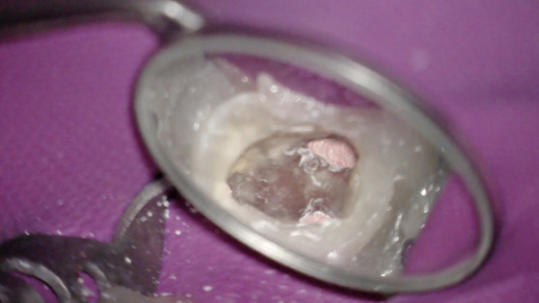 【根管治療・パーフォレーション】抜歯と言われた歯をマイクロスコープとレーザーを使用して根管治療を行なったケース