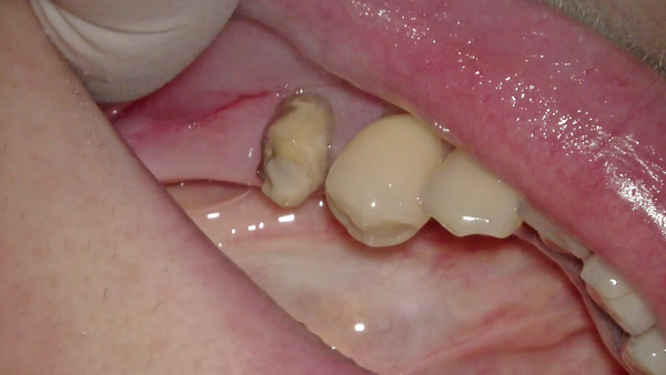 【根管治療・ラバーダム】左下の被せ物が外れた歯をマイクロスコープを使用して歯根治療