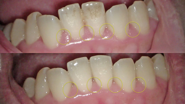 【歯周病治療・歯周組織再生療法】下の前歯の歯肉が痛みと違和感が続く方のマイクロスコープを使用して歯石除去