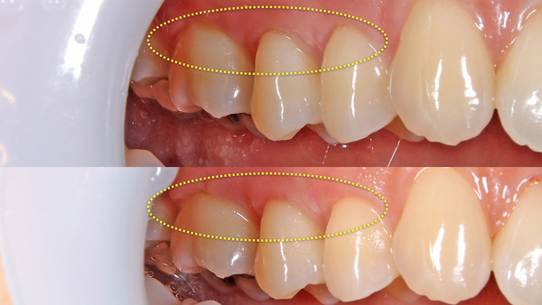 【歯周病治療・歯肉退縮・知覚過敏】右上奥歯がしみる症状と違和感がある方のマイクロスコープを使用して結合組織移植術(歯肉移植)