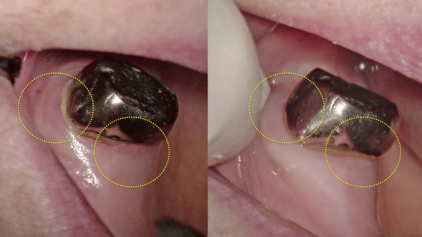 【歯周病治療・歯周組織再生療法】左上奥歯の歯肉に違和感がある方のマイクロスコープを使用してバイオフィルムや歯石除去