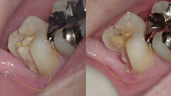 【歯周病治療・歯周組織再生療法】右下奥歯の被せ物がすぐ取れる