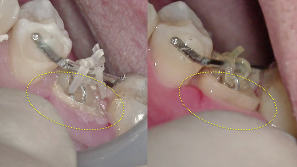 【歯を残す・エクストリュージョン】抜歯と言われた歯をマイクロスコープ使用して保存治療