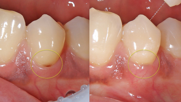 【歯周病治療・歯周組織再生療法】左下の歯の根面の色が気になる方の歯肉退縮の治療について