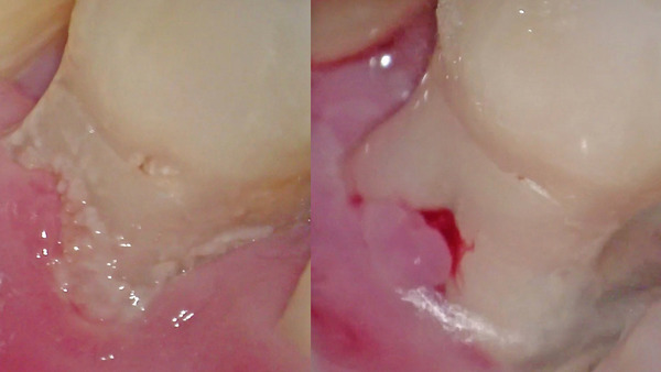 【歯周病治療・歯周組織再生療法・根分岐部病変】左上第一大臼歯の進行した歯周病(歯槽膿漏)治療
