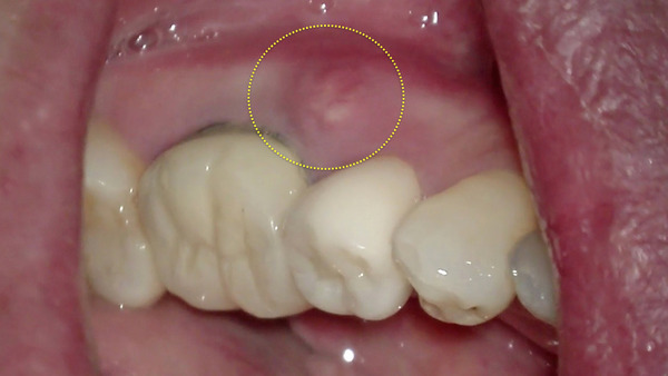 【歯を残す・ヘミセクション(歯根分割抜去法)】左下の奥歯の歯肉が腫れて痛い方の治療