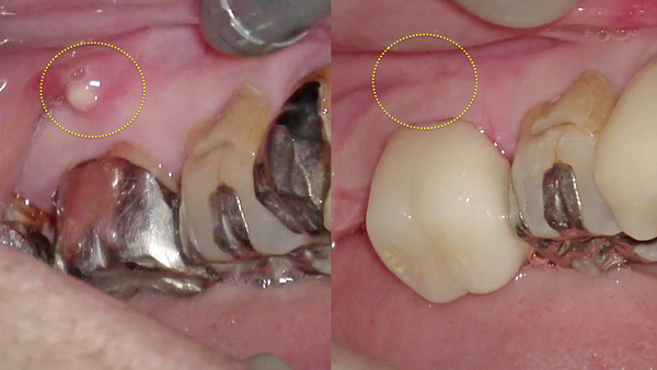 【歯を残す・セラミック治療】左下の奥歯の根管治療後のセラミック治療
