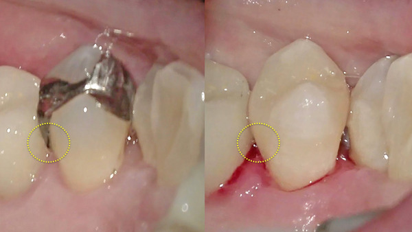【セラミック治療・むし歯(虫歯)治療】右上の歯にものがつまる。手術用顕微鏡で原因を探る。