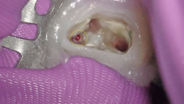 【根管治療・パーフォレーション】マイクロスコープを使用して左上第一大臼歯のメタルコア除去と根管治療