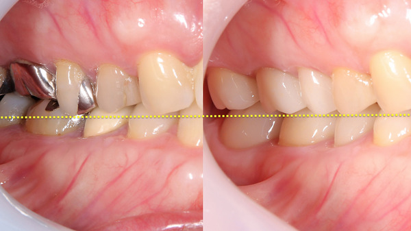 【セラミック治療・咬み合わせ】上下顎の被せ物の治療