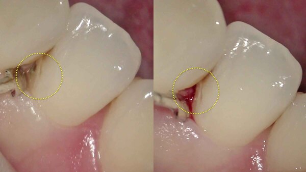 【歯周病治療・歯石】口臭が気になる方の歯周病(歯槽膿漏)治療