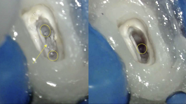【根管治療】マイクロスコープ(手術用顕微鏡)を使用した根管治療のイスムスについて