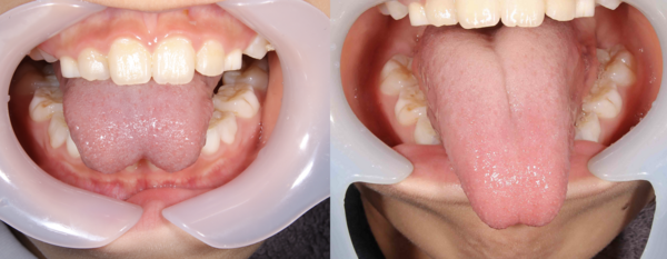【小児歯科・舌小帯短縮症】舌がうまく動かせないお子さんの治療