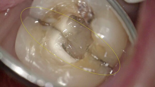 【根管治療・歯を残す】咬むと痛みが強い右下の奥歯の根管治療