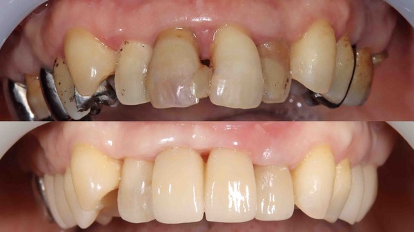 【歯周補綴治療・歯を残す】歯周病で前歯が揺れている方のセラミック治療