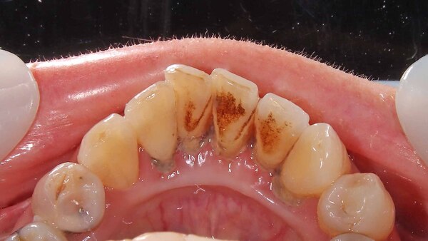 【歯周病治療・歯石除去】手術用顕微鏡(マイクロスコープ)を使用しての下の前歯の歯石除去