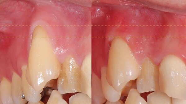 【歯肉退縮・歯周組織再生】マイクロスコープを使用して右上犬歯の根面被覆術