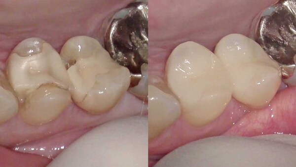 【セラミック治療・むし歯治療】右上の歯の詰め物が欠けた方のセラミック治療