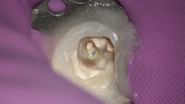 【根管治療・根尖病変・メタルコア除去】左下の奥歯の根尖病変の根管治療(未治療の根管の治療)