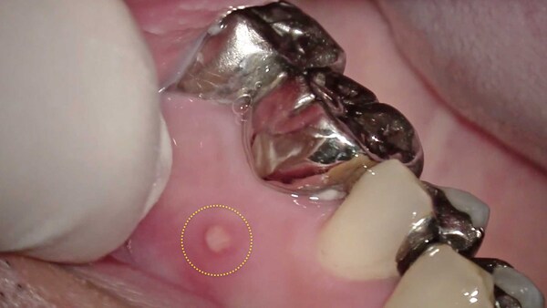 【根管治療・根尖病変】左上の銀歯の歯肉が腫れた方のコア(土台)除去