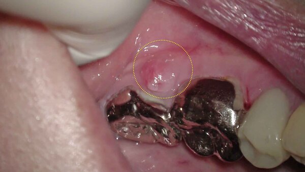 【歯を残す・ヘミセクション(歯根分割抜去法)】左下の奥歯の歯肉が腫れてた