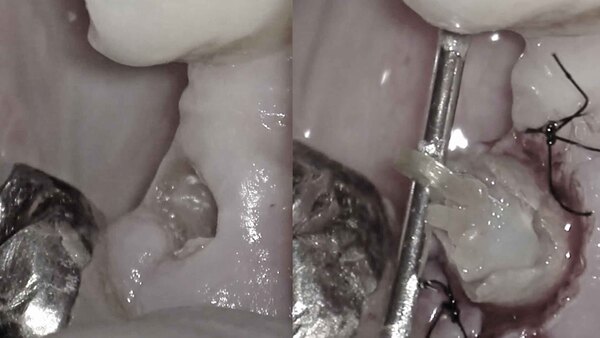 【歯を残す・エクストリュージョン】右下の歯を抜歯と言われた方の治療