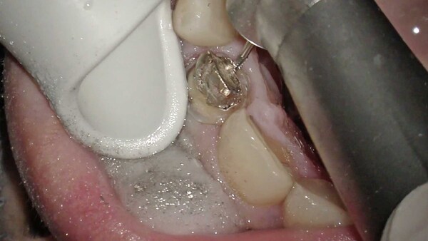 【根管治療・メタルコア除去】上顎前歯のメタルコア除去について
