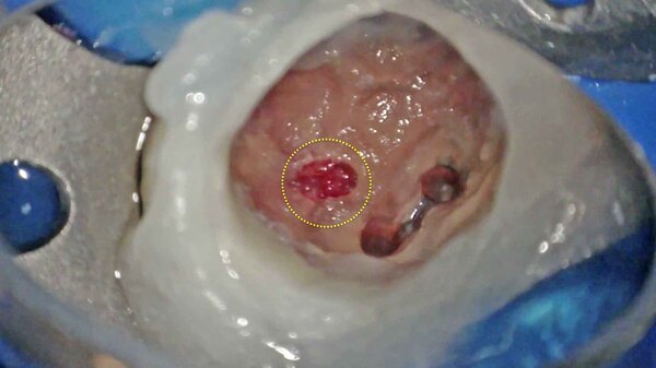 【根管治療・レーザー治療】自覚症状はなく手術用顕微鏡(マイクロスコープ)で見つかった深いむし歯の治療(根管治療＋パーフォレーション編)