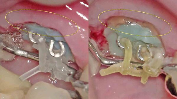 【歯を残す・エクストリュージョン】自覚症状はなく手術用顕微鏡(マイクロスコープ)で見つかった深いむし歯の治療(エクストリュージョン編)