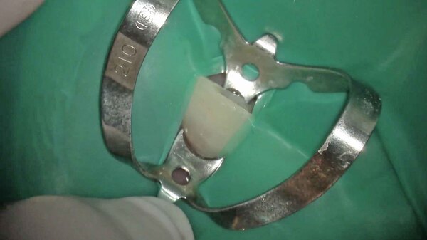 【根管治療・根尖病変】左上の前歯の根本と鼻の下を押すと痛い方の手術用顕微鏡(マイクロスコープ)エオ使用した根管治療