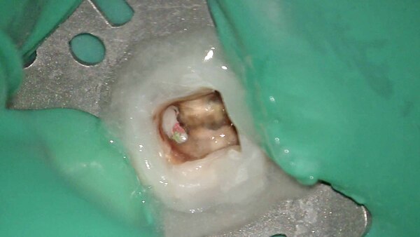 【根管治療・根尖病変】左下の奥歯の歯肉の腫れた感じが続く方の手術用顕微鏡(マイクロスコープ)を使用した根管治療