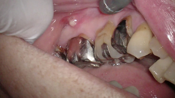 左下の奥歯(銀歯)の歯肉が腫れた①