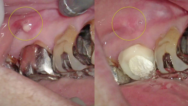 左下の奥歯(銀歯)の歯肉が腫れた③