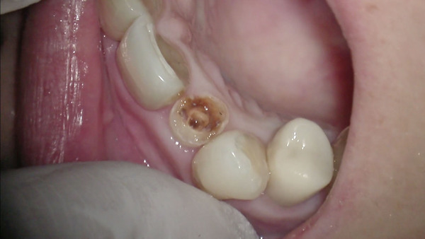 右上側切歯の治療について