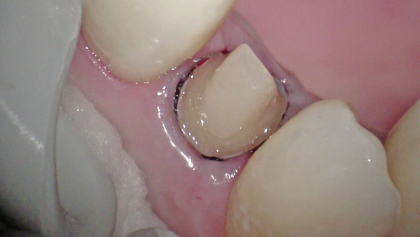 右上側切歯の被せ物の治療について