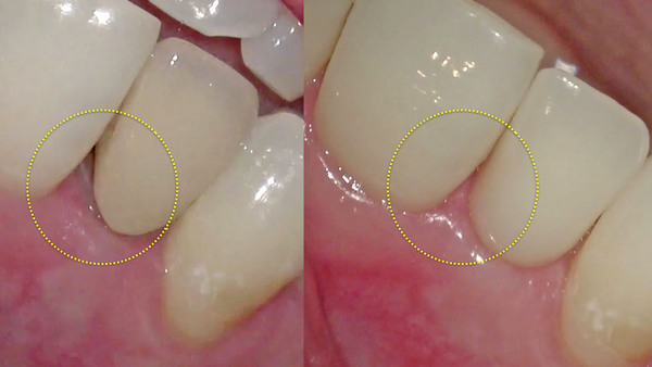 右上側切歯の被せ物(セラミッククラウン)のセット