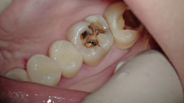右上奥歯のむし歯の治療