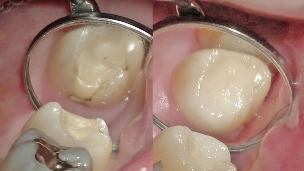 右上奥歯のむし歯の治療②