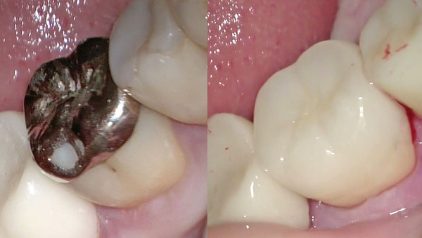 右下第一大臼歯のセラミック治療