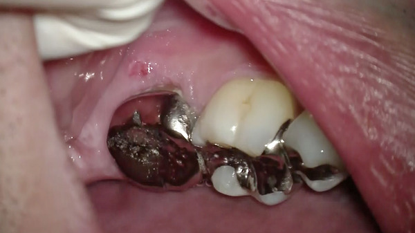 左下の奥歯の根管治療（破折器具除去編）