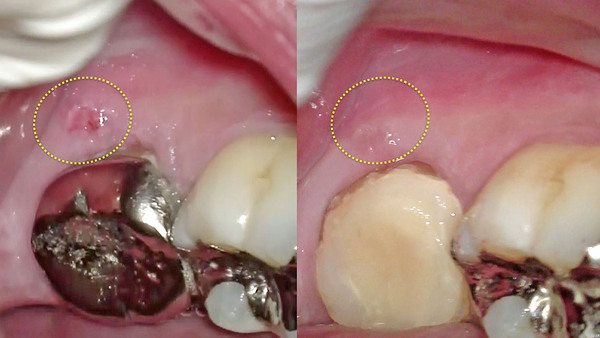 左下の奥歯の歯肉が腫れて根管治療の経過について