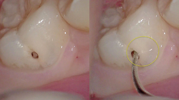 手術用顕微鏡(マイクロスコープ)を応用した右下第一大臼歯のむし歯(虫歯)治療