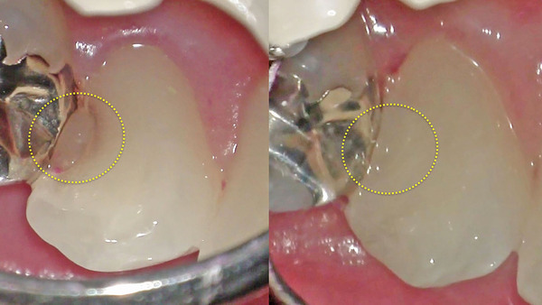 手術用顕微鏡(マイクロスコープ)を使用した左下犬歯のむし歯治療