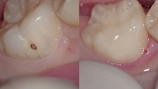 手術用顕微鏡(マイクロスコープ)を応用した右下第一大臼歯のむし歯治療(セラミック編)