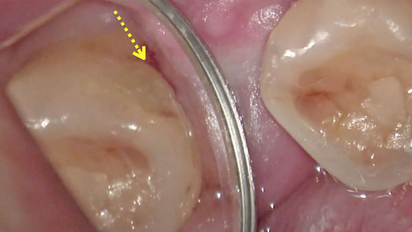 手術用顕微鏡(マイクロスコープ)を使用して左下第二大臼歯のむし歯(虫歯)治療